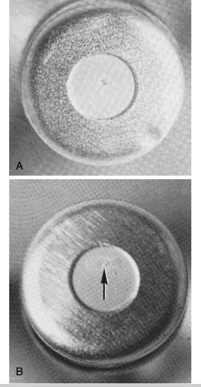 Hình 5.19. (A) Lỗ đâm đúng trung tâm trên màng cao su. (B) Lỗ đâm lệch tâm (mũi tên) sẽ gây rò rỉ thuốc tê.