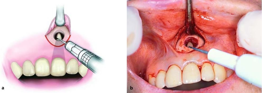 Phẫu thuật cắt chóp răng, tạo vát 45 độ.