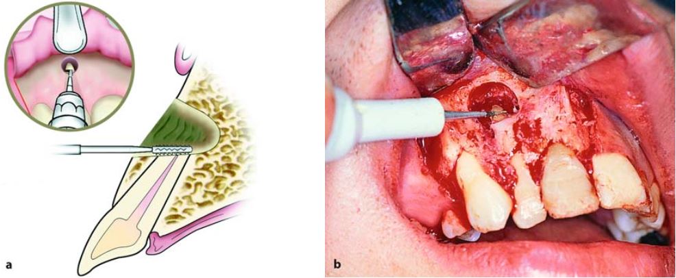 Cắt chóp bằng mũi khoan có rãnh, nghiêng 1 góc khoảng 45 độ. Phần chóp cắt đi khoảng 2-3 mm.