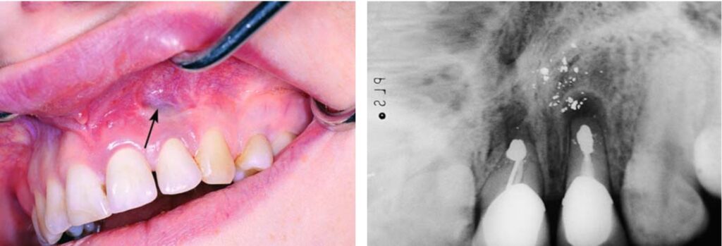 Nhiễm màu niêm mạc do Amalgam còn sót trong phẫu trường sau phẫu thuật cắt chóp.