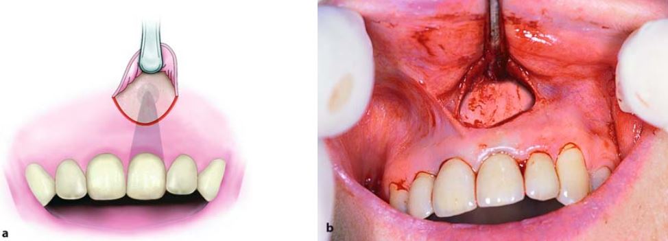 Lật vạt lên và mở rộng phẫu trường bằng cây bóc tách.