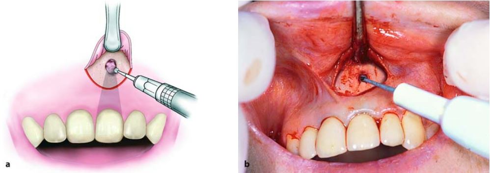 Loại bỏ xương quanh 1/3 chóp răng.