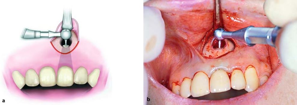 Sửa soạn xoang trám ở chóp bằng tay khoan đầu nhỏ.
