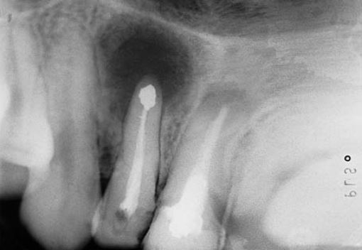 X quang được chụp trước khi khâu vạt cho thấy hình ảnh miếng trám ngược.