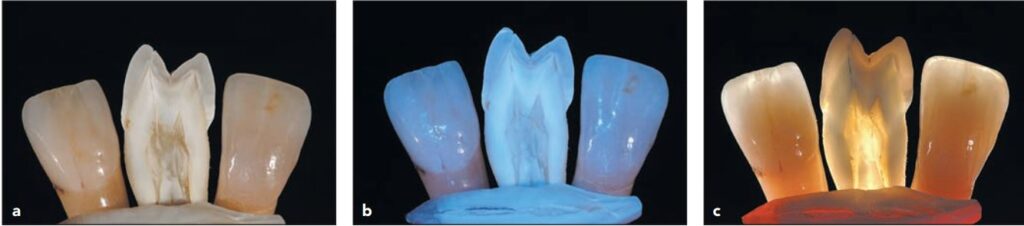 (a) Ảnh chụp dưới ánh sáng tự nhiên của 2 răng cửa đã nhổ (răng bên phải và răng ở giữa) và phục hình sứ (răng bên trái). Kĩ thuật viên đã lựa chọn vật liệu để mô phỏng lại răng thật rất hoàn hảo. (b) Ảnh chụp dưới ánh sáng phản xạ. (c) Ảnh chụp dưới ánh sáng xuyên qua. Răng sứ có độ trong mờ tương tự răng thật.