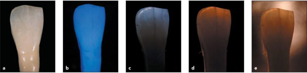 Ví dụ về các hiệu ứng ánh sáng trên răng thật. (a) Ánh sáng tự nhiên. (b), Fluorescence. (c) Opalescence xanh dương. (d) Opalescence cam. (e) Translucency.