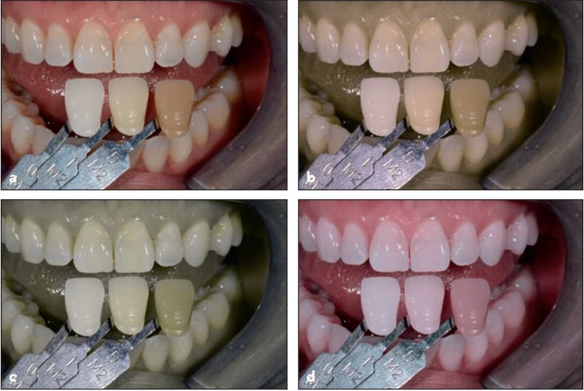 (a) Hình ảnh với màu sắc dưới mắt nhìn bình thường. (b) Chứng mù màu đỏ. (c) Chứng mù màu xanh lá và (d) Chứng mù màu xanh dương.