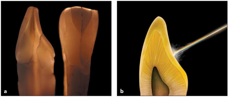 (a) HIện tượng opalescent cam, do sự truyền và hấp thụ ánh sáng bước sóng đo-vàng (cam) và sự hấp thụ ánh sáng có bước sóng xanh. (b) Minh họa sự truyền ánh sáng có bước sóng dài (cam) qua men và ngà răng.