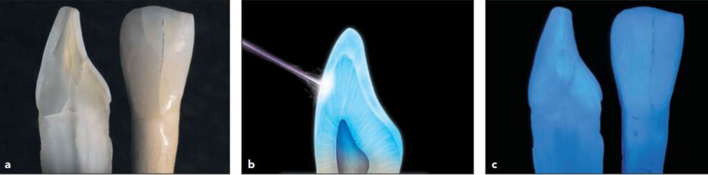 (a) Hình ảnh răng tự nhiên (đã nhổ) dưới ánh sáng ban ngày tự nhiên. (b) Hình ảnh minh họa cách ánh sáng cực tím (ultrviolet UV) tương tác với các tế bào của ngà răng, làm phát ra các tia phản xạ. Hiện tượng này được gọi là huỳnh quang (fluorescence). (c) Răng ở hình a dưới ánh sáng cực tím (UV), chú ý độ huỳnh quang của lớp ngà cao hơn lớp men.