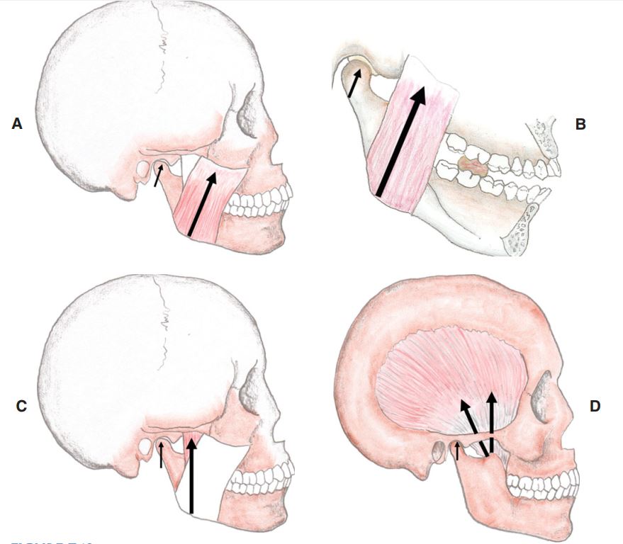 A, Cơ cắn (bó nông) (superficial masseter) kéo lồi cầu lên trên, về phía sườn sau mỏm khớp. B, Cơ chân bướm trong (internal pterygoid  muscle) từ phía trong của xương hàm dưới cũng kéo lồi cầu lên trên. C, Cơ cắn (bó sâu) (deep fibers of the masseter muscles) kéo lồi cầu lên trên. D, Cơ thái dương (bám tại mỏm vẹt), vị trí bám cơ ở giữa răng và lồi cầu, cũng kéo lồi cầu lên trên.