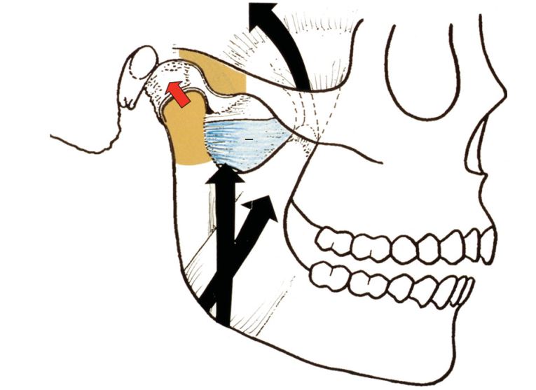 Khi các cơ phối hợp hoạt động, bộ 3 cơ nâng hàm sẽ kéo phức hợp lồi cầu – đĩa khớp lên sườn nghiêng phía sau của lồi khớp. Bụng dưới của cơ chân bướm ngoài luôn giãn trong quá trình đóng hàm nếu như không có cản trở khớp cắn.