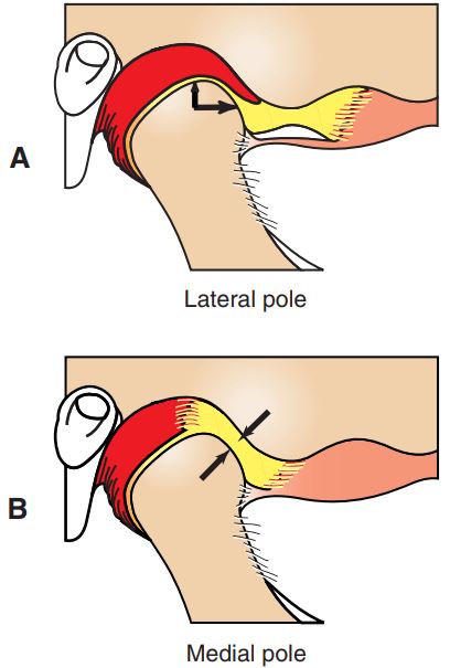 Cực ngoài và cực trong lồi cầu.