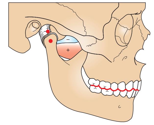 Chỉ lên giá khớp với mẫu hàm ở lồng múi tối đa (LMTĐ) không thể cho biết hướng điều trị để đạt được sự hài hòa giữa khớp cắn và TMJ.