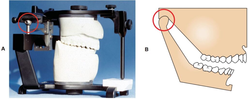A, Lên giá khớp mẫu hàm ở tương quan trung tâm và B, lập kế hoạch điều trị dựa trên sự hài hòa với tương quan giữa hàm trên và hàm dưới.