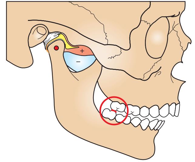 Vị trí 2 hàm khi ở tương quan trung tâm cho thấy sự khác biệt so với ở lồng múi tối đa.