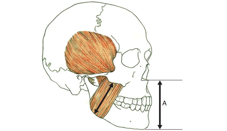 Khi lực làm mọc răng bị ngừng lại bởi tương quan vị trí hàm dưới so với hàm trên thì kích thước dọc cắn khớp VDO (A) là kết quả từ độ dài của hệ thống cơ nâng hàm có được trong suốt quá trình co lặp đi lặp lại.