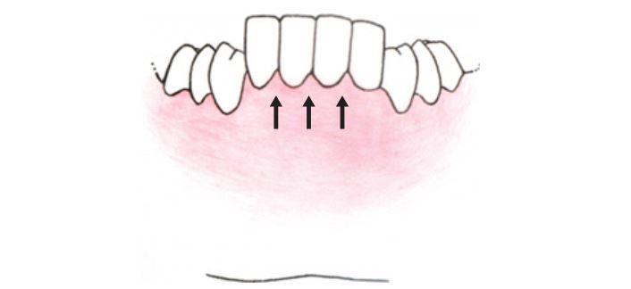 Chú ý các răng trước và xương ổ răng tiếp tục mọc dài ra khi không có tiếp xúc phía trước.