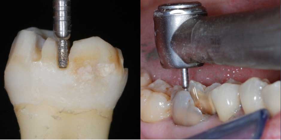 Tạo rãnh hướng dẫn Endocrown